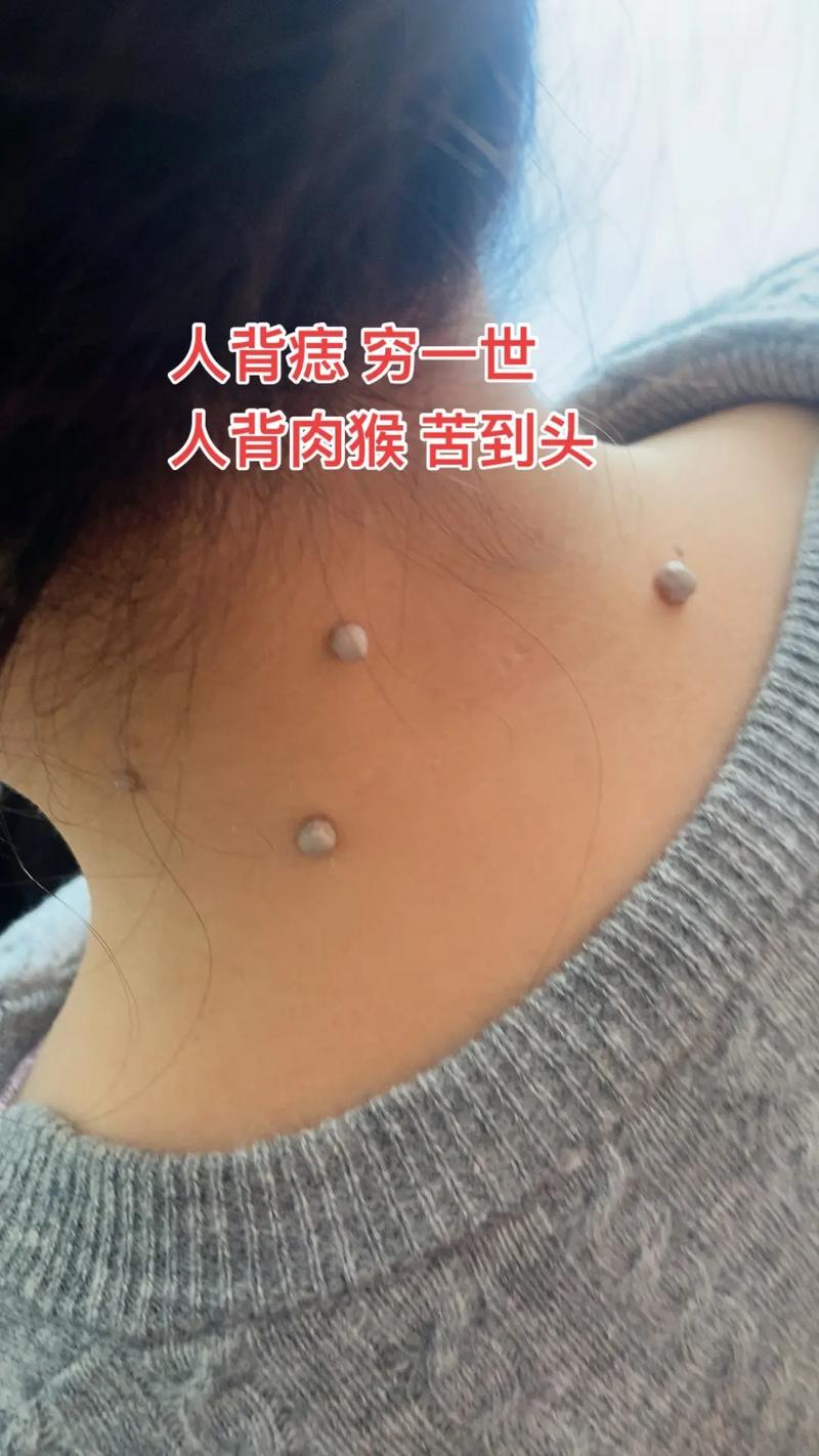 后背有猴子命运（背上有瘊子）的人命运究竟如何？