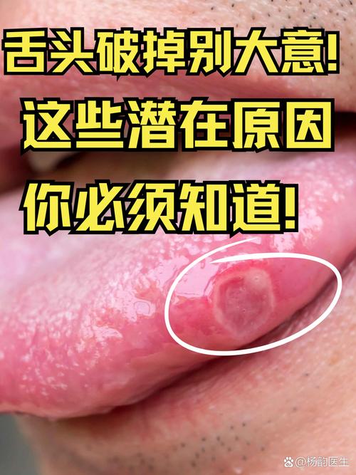 咬破舌头是什么征兆，预示着什么不好的事情即将发生？