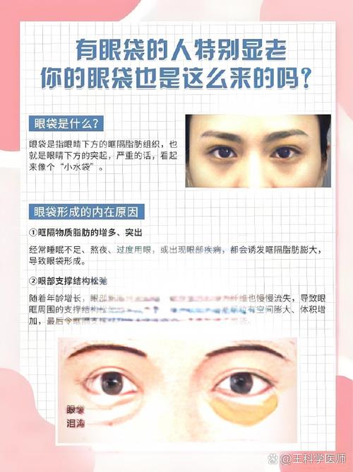 女人肿眼泡是福气的象征吗？肿眼泡形成的原因有哪些？