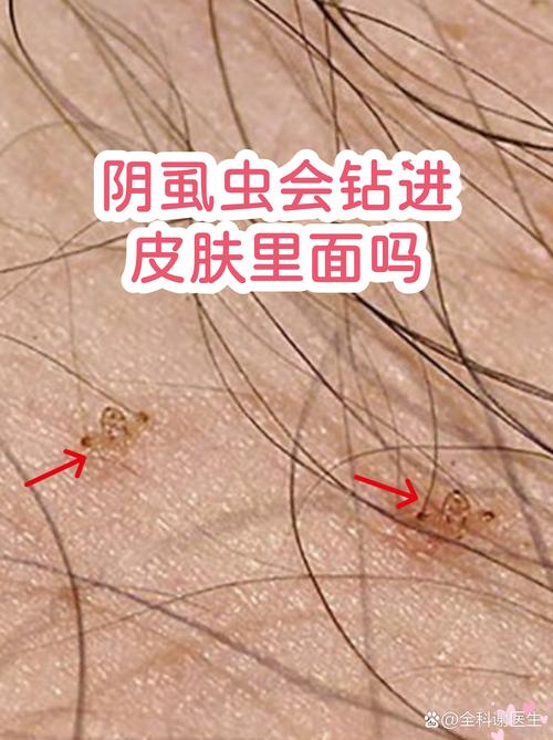 梦见虫子钻进皮肤里是什么预兆或象征？