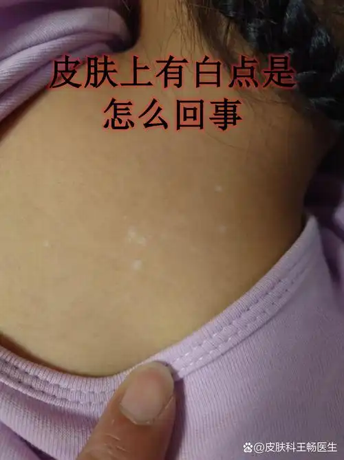 梦见脸上出现白点点是什么预兆？