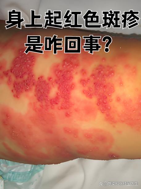 梦见老公后背红点是什么征兆？预示着什么？