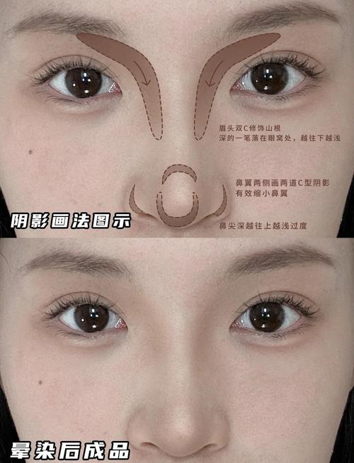 如何同过非手术方式改善蒜头鼻的外观？