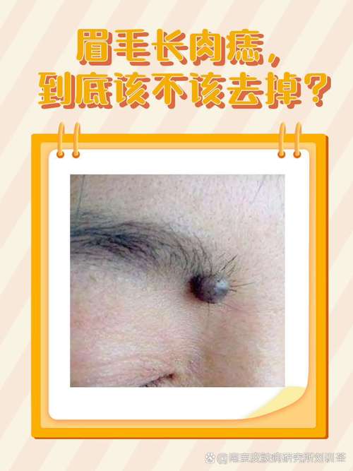 眉毛痣上的白色小肉球凸起，对眉毛美观和健康有影响吗？