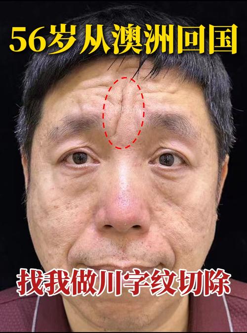 额头皱纹对男性命运有何影响？