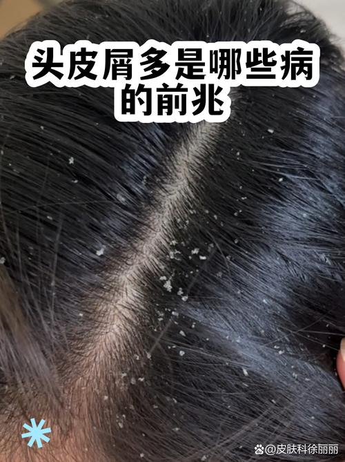 梦见头皮屑大量掉落是什么征兆或含义？