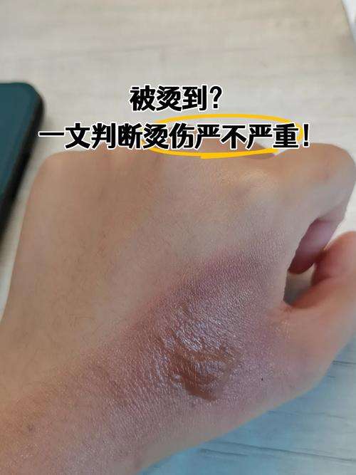 梦见自己被烫伤是什么预兆？预示着什么不好的事情会发生吗？