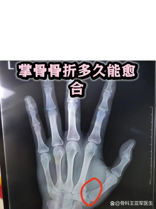 梦见手骨折骨头外露是什么预兆？预示着什么不幸或警告？