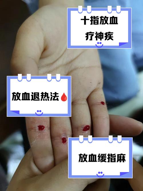 梦见手指上被扎满针是什么预兆或含义？