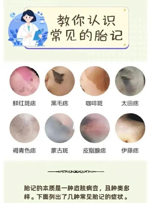 面相中耳后胎记是什么意思？有什么特殊含义？