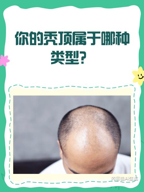 秃顶男生性格特点有哪些？