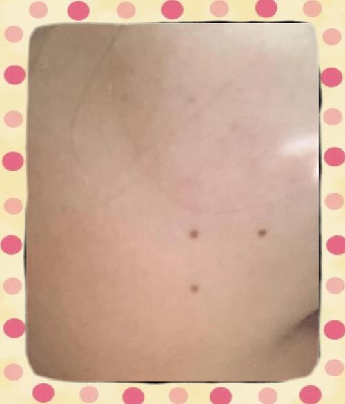 三颗痣形成三角形的人命运究竟如何？
