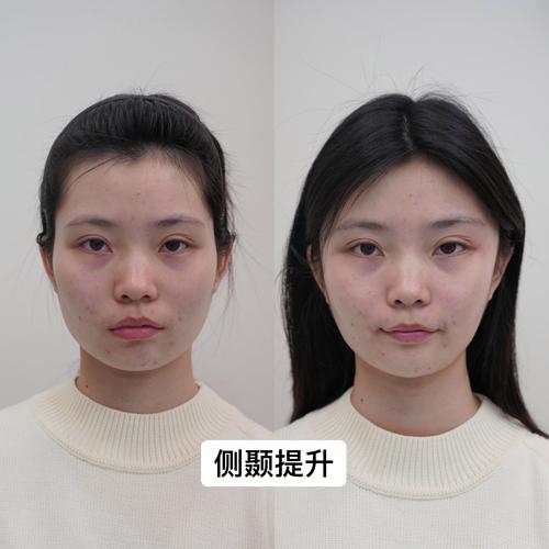 女生太阳穴凹陷会影响颜值吗？这是真的吗？