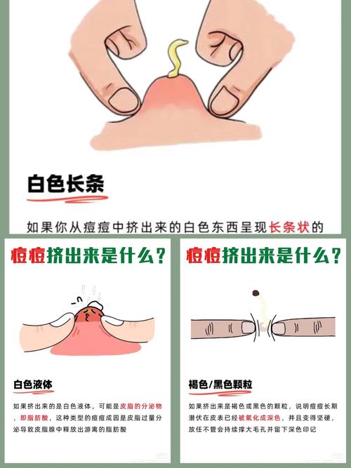 梦见脸上长痘痘挤出来是什么预兆？