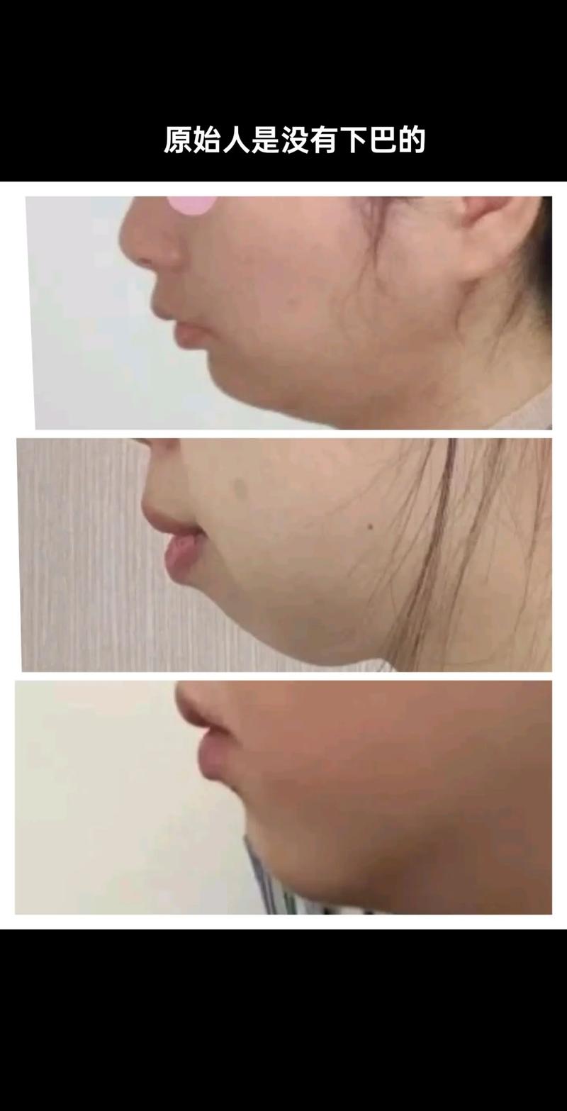 为什么有些人看起来下巴不明显或没有下巴？