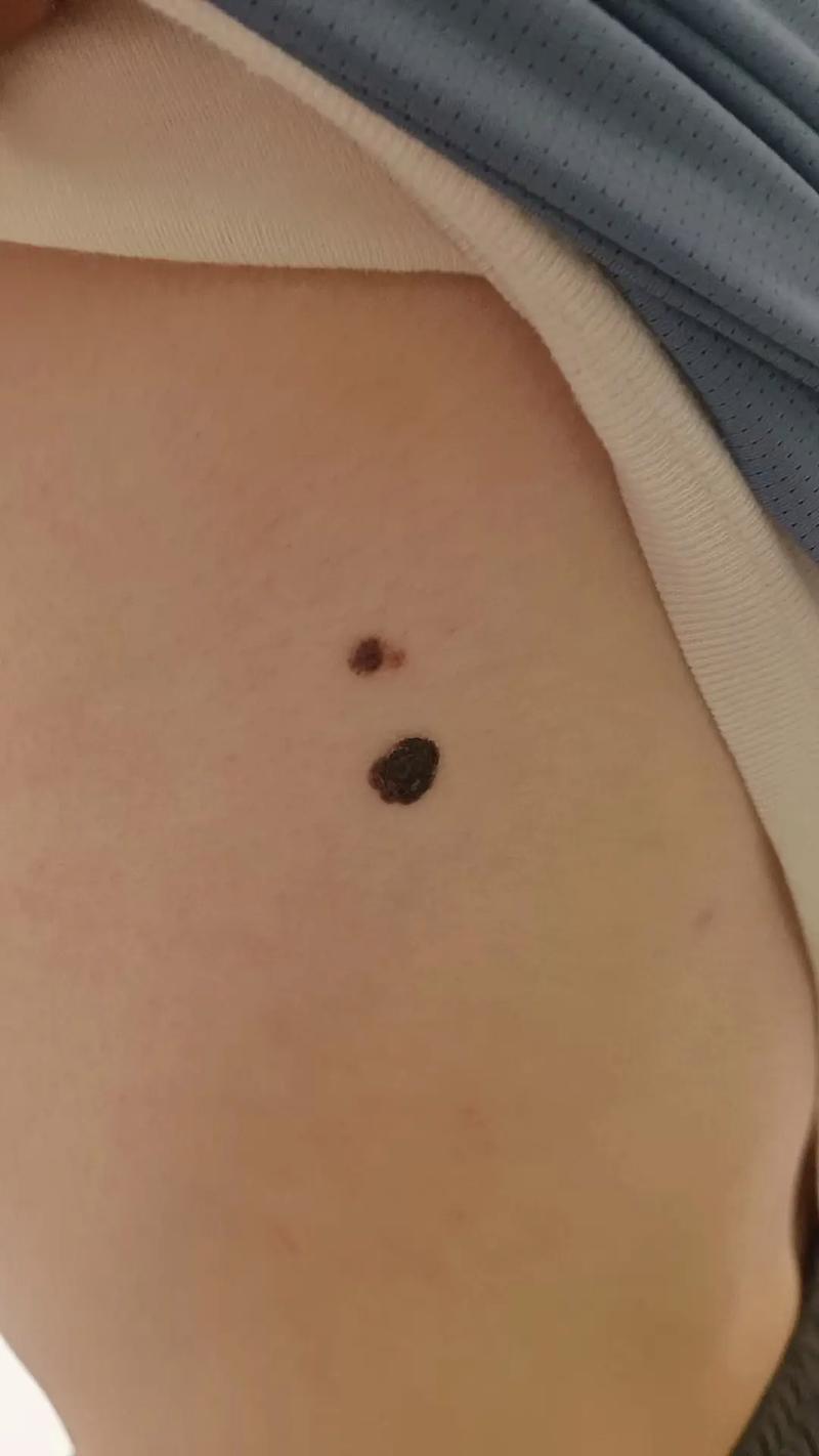 眉毛里长的痦子或痣有恶变或癌变的可能吗？