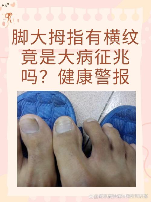 大拇指横纹多是什么手相，脚大拇指也有类似横纹吗？