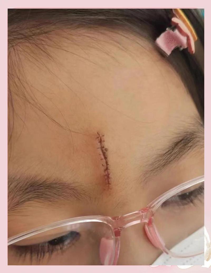 额头眉毛处撞墙角后裂痕怎么办？如何处理眉毛到额头间的伤口？