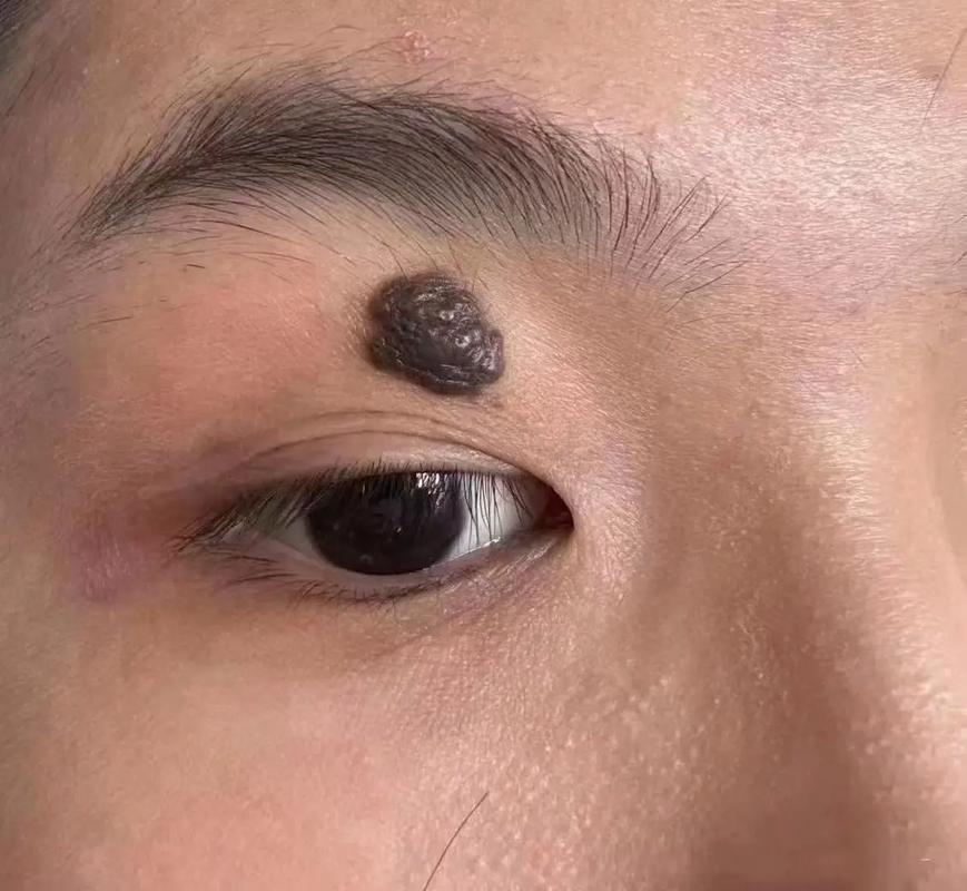 眉毛里长的痦子或痣有恶变或癌变的可能吗？