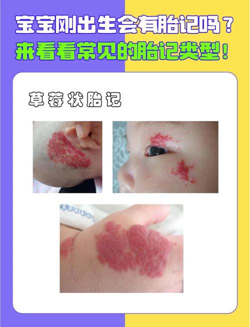 佛说脸上有胎记的人或孩子，他们有什么特殊含义或命运吗？