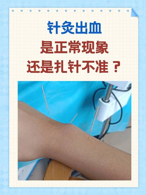 梦见针灸出血是什么预兆？预示着什么不好的事情？