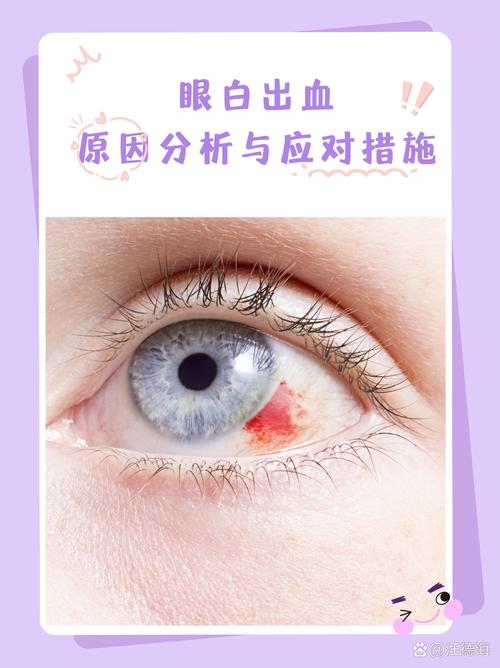 梦见自己眼睛出血是什么预兆或含义？