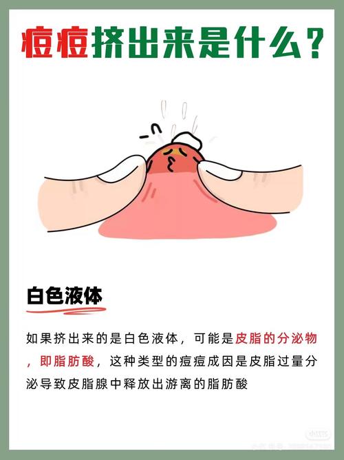 梦见脸上长痘痘挤出来是什么预兆？