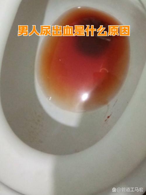男生梦见自己尿血是什么征兆？预示着什么不好的事情？