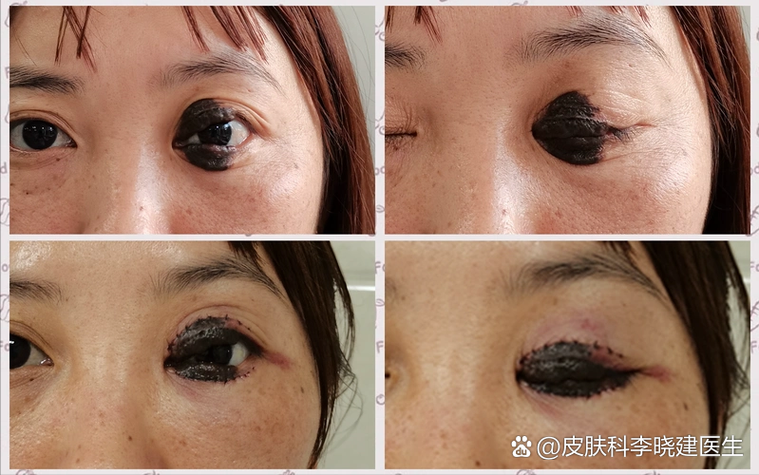眼皮上的胎记面相有什么特殊含义？