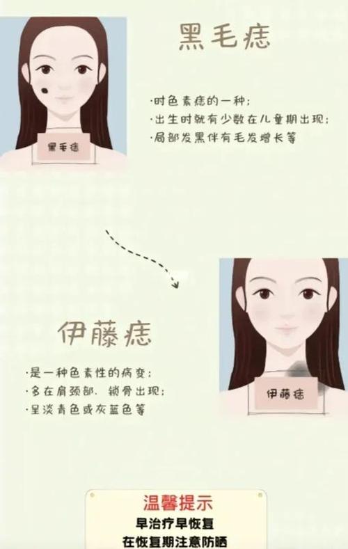 面相中耳后胎记是什么意思？有什么特殊含义？