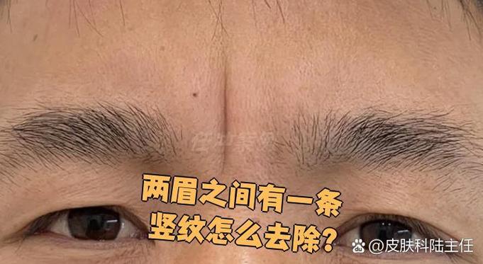 眉毛中间两条竖纹是什么原因，如何去除？