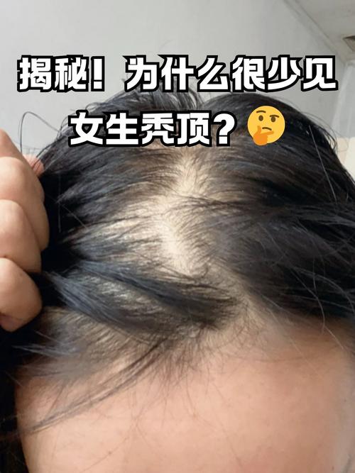 女人头顶中间秃，这样的面相命运会怎样？