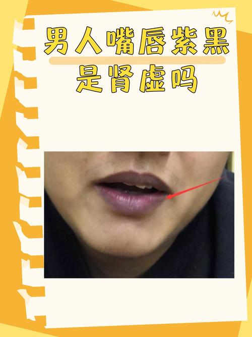 面相紫黑和皮肤嘴紫黑是否正常，有什么含义？