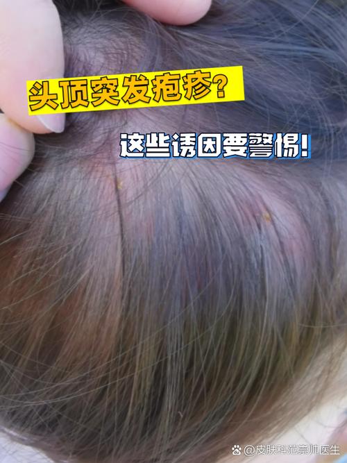 女人梦见头上长疮是什么预兆或象征？