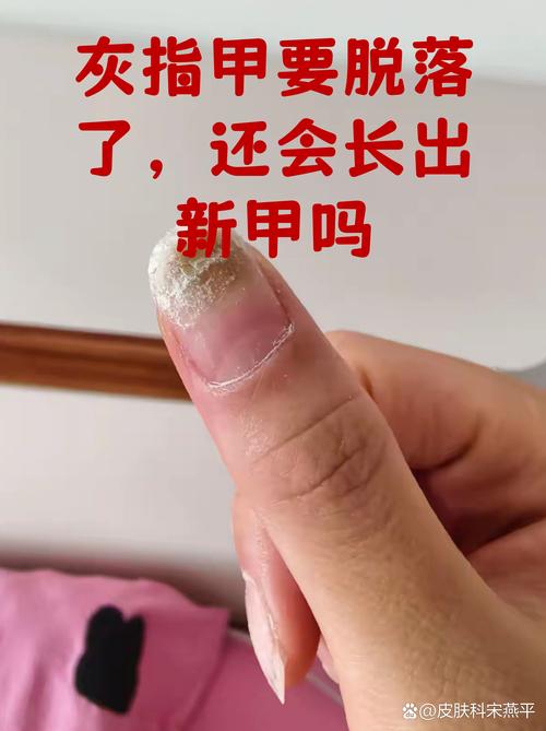 梦到手指甲盖掉了是什么预兆？预示着什么不好的事情即将发生吗？