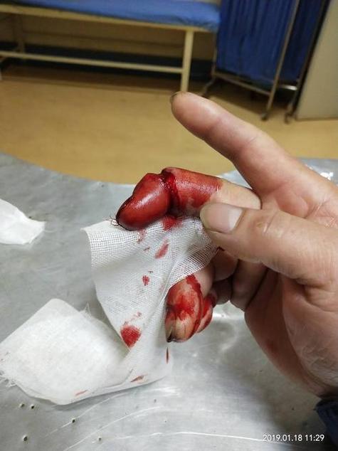 梦见别人手指头断了一根是什么征兆或预示？