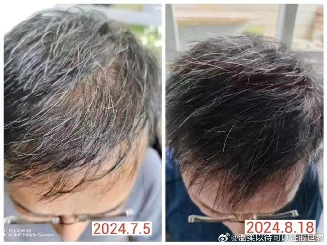 梦见头发一半黑一半白是什么预兆或象征？