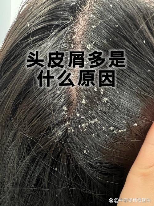 女人梦见自己满头头皮屑，头皮屑很多很大块是什么预兆？