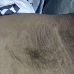腋窝胎记一片预示着怎样的命运？是什么原因导致腋窝出现类似胎记的片状物？