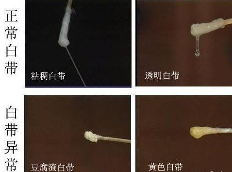 你是不是也被冬季白带异味困扰得迅速崩溃了？