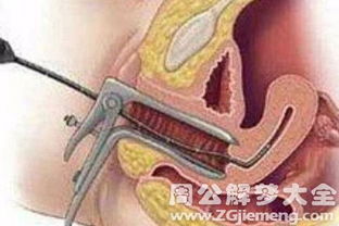 梦见别人即将流产，这是否预示着什么不幸即将发生？