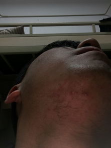 下巴上长痘痘又硬又痛,下巴上长痘痘又硬又痛