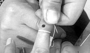 放血的意思,民间放血