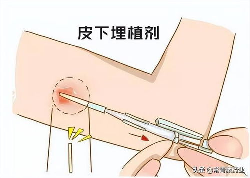 a) 宫腔粘连：肿瘤也想跟随你一起繁衍?