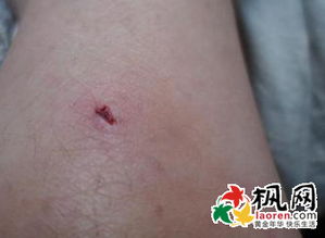 梦见自己大腿变黑是什么征兆？预示着什么？