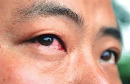梦见老公眼睛变可怕，预示着什么眼病或征兆？
