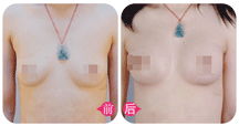 如何有效矫正八字胸，这种胸型是否需要改善？