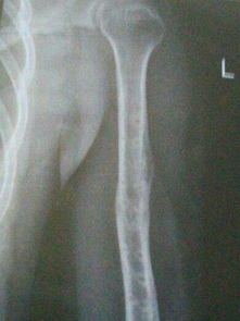 骨头痛的人,骨头痛的人