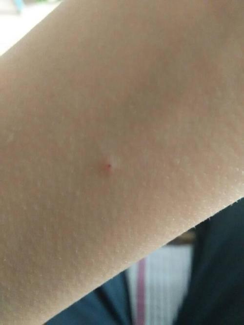 床上睡觉痒是什么原因,有红包有螨虫吗