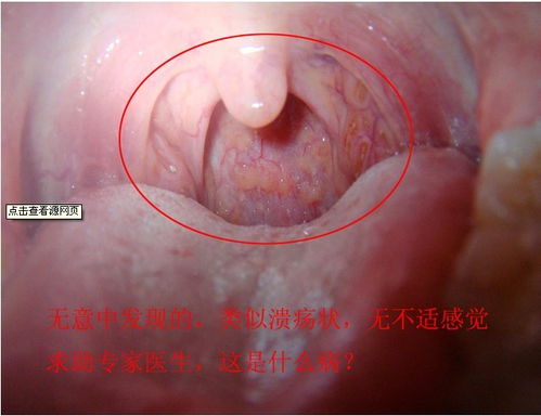 喉窝有红痣是哪种命理说法？